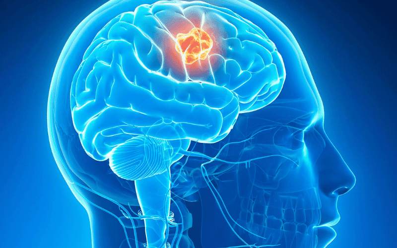 brain-tumor