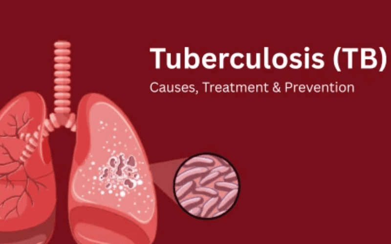 tuberculosis