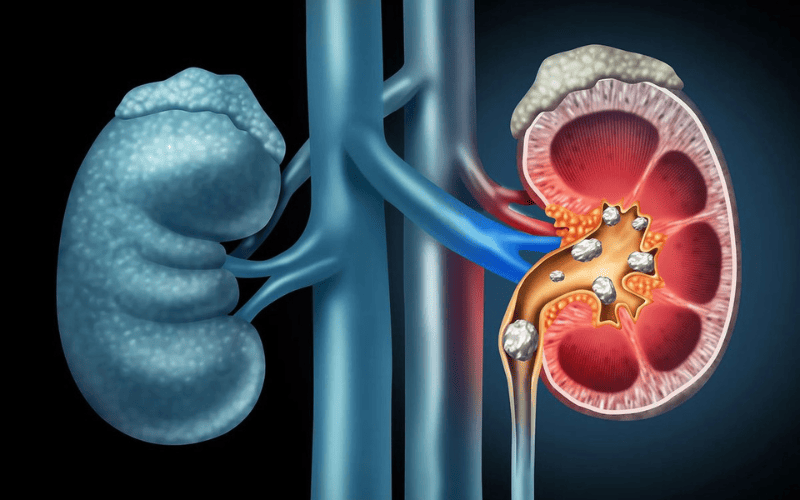 understanding-kidney-stones