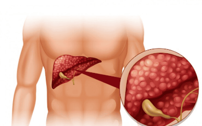 understanding-liver-cancer